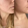 Microbiote & Peau