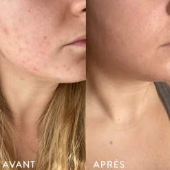Microbiote & Peau